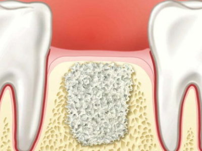 імплант синус ліфтинг київ