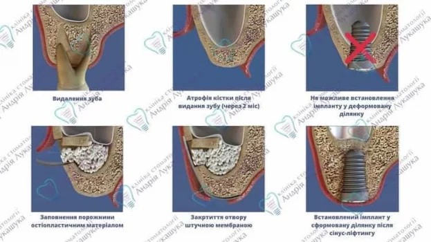імплант синус ліфтинг київ