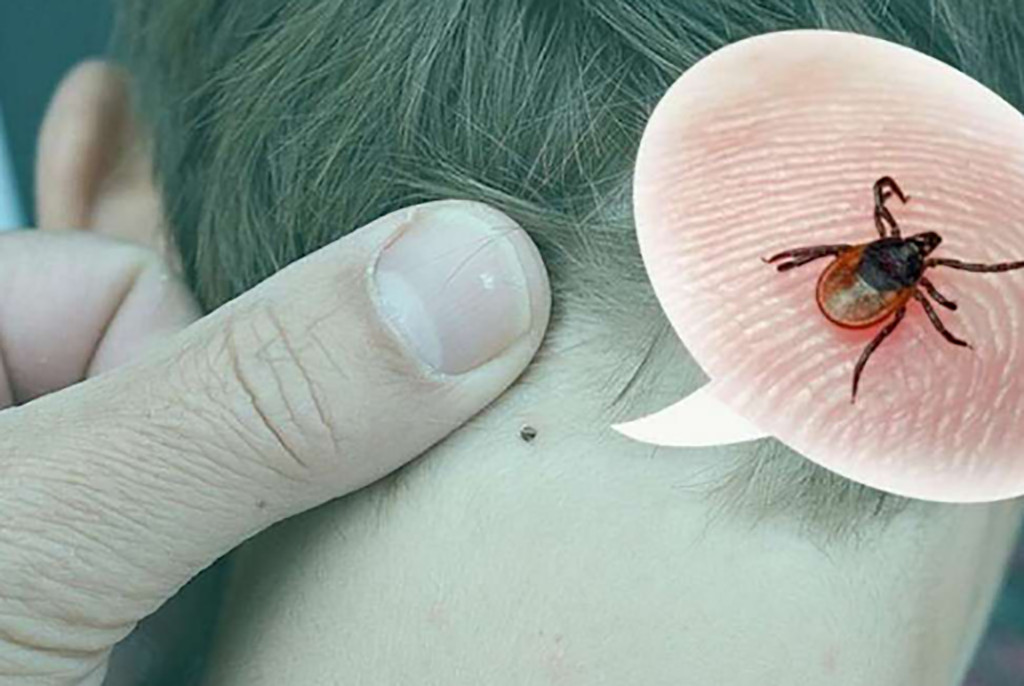 укуси кліщів